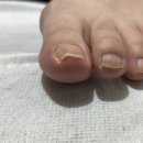 매료네일 문제성전문점 | [부산/서면] 내성발톱 교정하러 매료네일 문제성 전문점 방문 후기_내돈내산