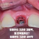 멍크라운 | 임플란트 크라운 재탈락, 왜 반복될까요? 원인 체크리스트