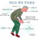 파킨슨병 치료, 침·봉독약침 한방치료 병행하면 효과적 이미지