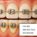 수완반석치과의원 | 수완지구치과 치아교정 중 관리 방법