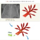 신생아 호흡곤란 증후군 (infantile respiratory distress syndrome) 이미지