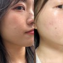 외 제 | 건대피부과 인모드후기 fx 포마 당일 멍 일주일 변화 효과