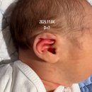 네잎클로버 | 광주 신생아 귀접힘 귀교정 H6188 네잎클로버 후기 병원정보 귀모양 변화 및 비용 보험 셀프 귀교정기...