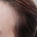 라인 무바늘 레이저 두피 문신 후 아트 겔러리 아이쇼핑 후기, 두피문신 가격 장점 단점 부작용 통증...