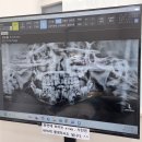 연세나을병원 | 7살 아이 치아 충치 신경치료 / 송도 연세세이브 치과 후기