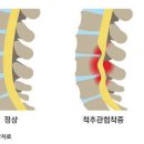 왼쪽 오른쪽 다리저림 다리가 저려요 원인 이미지