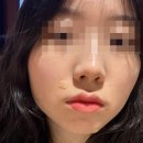 아그네스뷰티 | [피부과] 할리우드/듀얼 제네시스/엑셀브이/포텐자/프락셀/아그네스/카프리 등 1회차 솔직후기