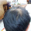 모아만의원 | 모발이식 7년 후기, 모아만 의원 짱입니다