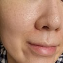 대구피부과 리쥬엘의원수성점 리쥬란힐러 후기