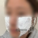 원레이져 | 리팟레이져 흑자 제거 후기 (더러움 주의 ❌)