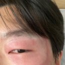 보람외과의원 | 선천성 오타모반 치료후기(라움성형외과)