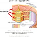 [난임일기 (4)] 시험관 동결배아 난자채취 후유증 / 에이치아이여성의원