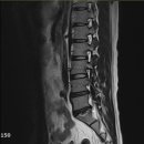 허리디스크로 고생하고 있습니다 ㅠ 2년째... 이미지