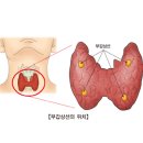 부갑상선기능항진증[Hyperparathyroidism]유방내분비질환 이미지