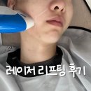성형시술 어플 바비톡, 강남언니, 여신티켓 레이저 리프팅 시술 후기 바비톡 강추!