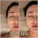 리빙에스테틱 | 범물역피부관리 윤곽과 수분관리를 한번에!정에스테틱 추천 물방울초음파관리와 파워트리관리 솔직후기!!