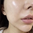 또팔자 | 팔자주름 시술 올리디아 후기 젊어지자 (연신내 피부과)