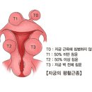 자궁의 평활근종[Leiomyoma of uterus] 이미지