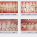 고운플란트치과의원 네이버블로그