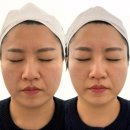 인더라인 | 이수역 피부관리 추천 인더뷰티 페이스핏톡스 후기 얼굴라인 관리 만족