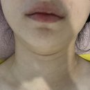 브니엘메디칼 | 구미 인동 피부관리 피부샵 브니엘뷰티 이중턱 슈퍼맥스