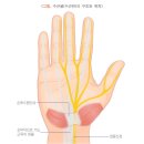 수근굴(수근관) 증후군carpaltunnelsyndrome 이미지