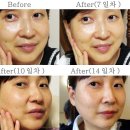 놀라운 피부변화- 스마트 부스터 리프퓨전 플라즈마 2주 생생 체험후기예요~