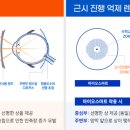 수정안경 이미지