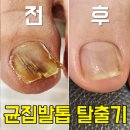 14개월간 여자 엄지발톱무좀 관리 답십리네일하랑 후기