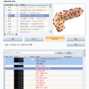 Re: Re: 췌장암 AN.YS- 58 BEN으로 CANCER 따라잡기 이미지