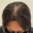 니들아트디자인 | 울산 남구 두피문신 | 20대 여성 가르마 커버 시술 후기 - 두아트스칼프