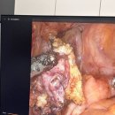 본죽엔비빔밥 속초점 | 경주동국대병원 심부자궁내막증 김도균교수님 수술후기 2