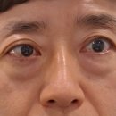 함박눈성형외과의원 | 남성 중년눈수술 하안검수술 강남역, 신사역 상담후기!(오브제, 리아이, 함박눈성형외과)