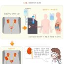 신장장애 판정기준[장애의 정도가 심하지 않은 장애인:신장을 이식받은 사람] 이미지