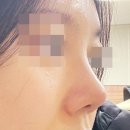 예뻐;진 | 비개방 복코교정수술 후 슬림 오똑해진 후기