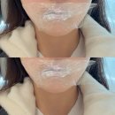 세븐일레븐 부산서면스타점 | 서면피부과 스타도 맞는 입술필러 얇고 작은 입술 1cc 볼륨 후기