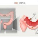 게실염 증상 원인 치료 게실염 예방법 이미지