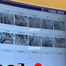 파주탈모 /운정탈모 관리 전문센터 &lt;모바이오&gt; 두피 MTS 1회차
