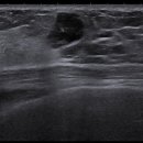 Sonograhphic Features of Adenosis Tumor 이미지