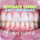 맑고밝음교정치과기공소 | 라미네이트. 앞니 레진 벌어짐을 자연스러우면서 화사하게 바꿔봅시다. 신사역 치과. 치료후기/비용/가격.