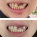 이가가머리하는곳 | [대문니 임플란트 후기] 2030여자, 사고로 앞니 3개 임플란트하게 된 약 5개월의 여정 총 정리