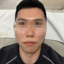 대전 둔산동 여드름 압출 전문 오와스킨에서 피부 관리 받은 후기 입니다!
