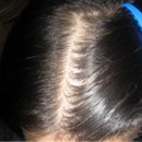 모생한의원 | 여성 정수리탈모 16주차 치료후기