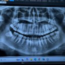서울아이브치과의원 | [서울, 광진] 광나루역 치과 서울오래치과의원/내돈내산 사랑니 빼고 온 후기