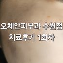 [경기/망포역] 오체안피부과 1차 치료 후기 /내돈내산