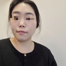 송도 연수구 피부과 리프팅 l 슈링크 유니버스 3주 간의 후기 :)