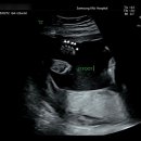 F103 | 임신 20-22주차ㅣ삼성미즈산부인과 정밀 초음파, 문화센터 임산부 필라테스 신청