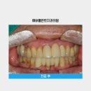 에버플란트치과의원 네이버블로그