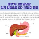 담낭암 담도암 초기 증상 원인 예방법은 없는걸까 이미지