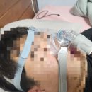 메드맥스 | [양압기]레스메드 양압기 착용하고 광명찾은 후기 (숨수면클리닉 일산점에서 받아옴)